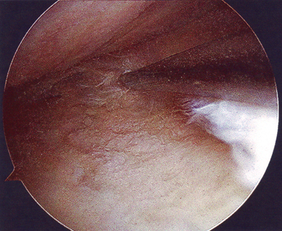 Sis�kierukan repe�m� syv�ll�