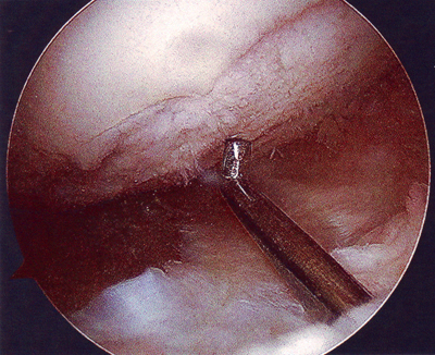 Sisäreiden rustokuluma